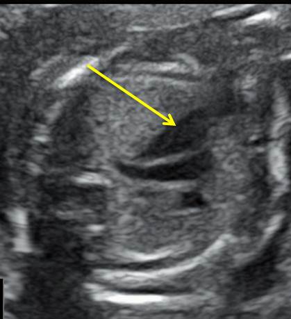 heart1-6-11.jpg